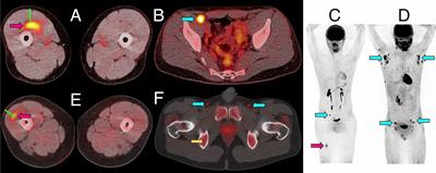 Systematic Evaluation of Kinetics and Distribution of Muscle and Lymph Node Activation Measured by 18F-FDG- and 11C-PBR28-PET/CT Imaging, and Whole Blood and Muscle Transcriptomics After Immunization of Healthy Humans With Adjuvanted and Unadjuvanted Vaccines